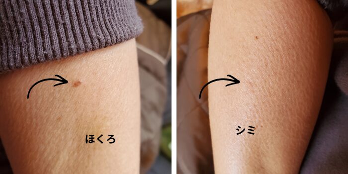 樟脳オイルを塗っているほくろと腕のシミ