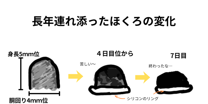 ほくろが取れるまでの図