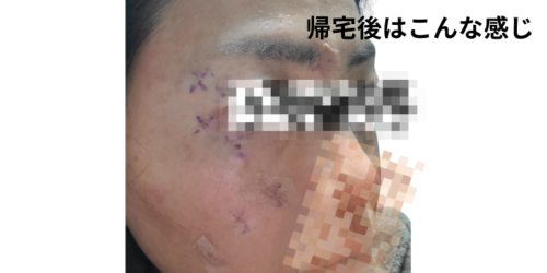 ほくろ除去後の肌