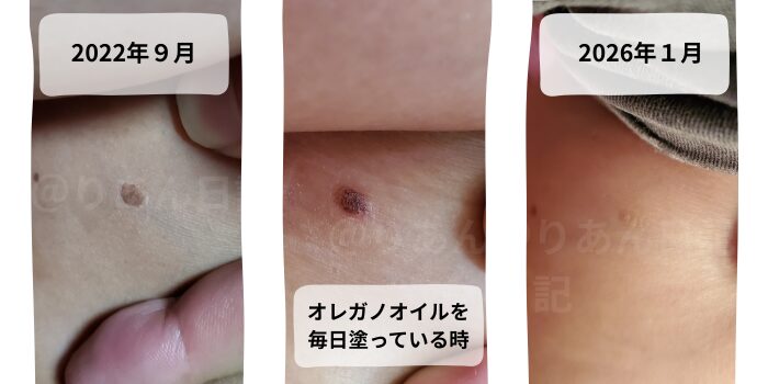 オレガノオイルをシミのようなものに塗って取れた様子