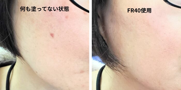 ほくろ除去後の跡にカバーマークのフローレスフィットを塗った状態